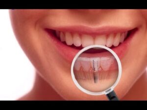Dental Implants Spring Hill