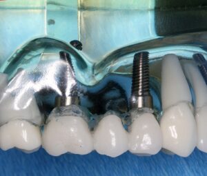 Dental Implants Ridge Manor