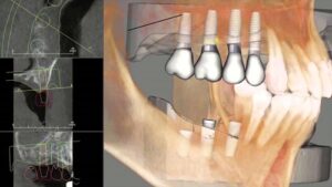 Dental Implants Masaryktown