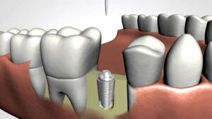Dental Implants Trinity