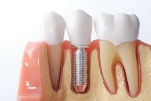Dental Implants Land O Lakes