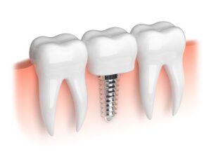 Dental Implants Port Richey