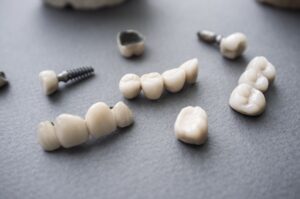 Dental Implants Zephyrhills