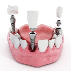 Dental Implants St. Leo